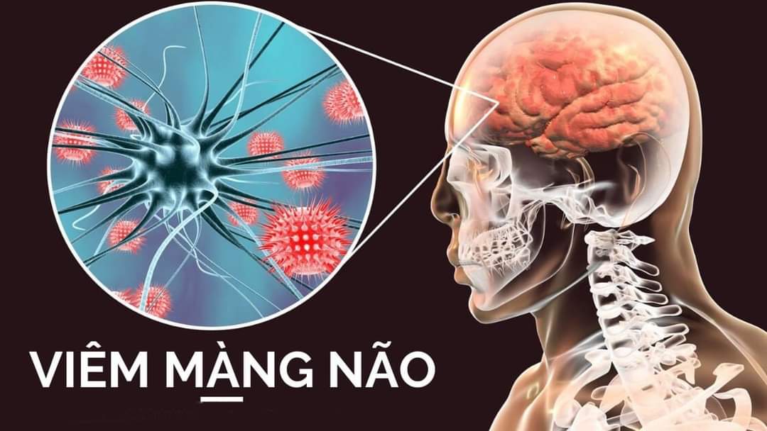 Bộ Y tế khuyến cáo các biện pháp phòng bệnh não mô cầu